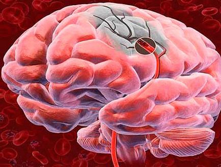 Neuroterapia câștigă accident vascular cerebral, știri economice