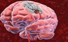 Neuroterapia câștigă accident vascular cerebral - medicamente rusești