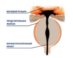 Caracteristicile hipertensiunii prostatei cu tsdk