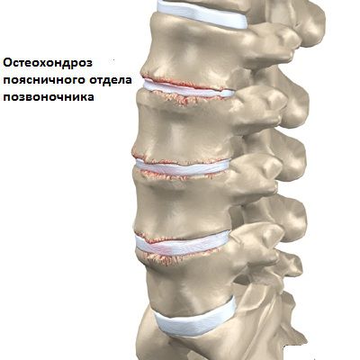 Osteochondrosis és fürdőben fontos tudni, amikor meglátogatja a gőzfürdő