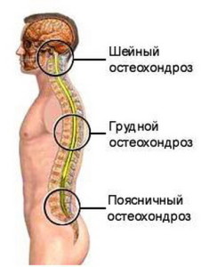 Остеохондроз хребта - види захворювання, лікування