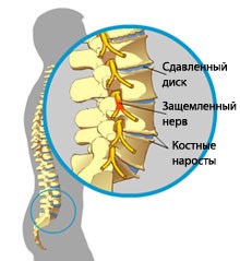 Остеохондроз хребта - види захворювання, лікування