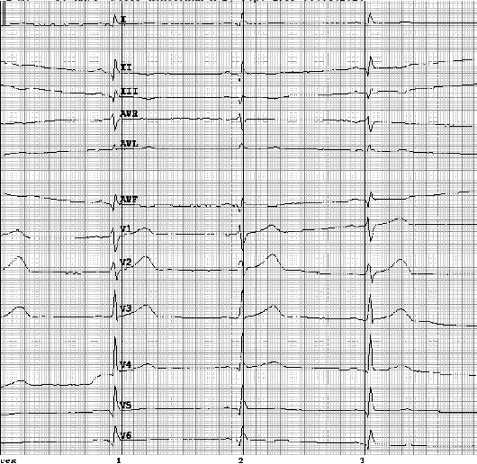 Sindromul coronarian acut