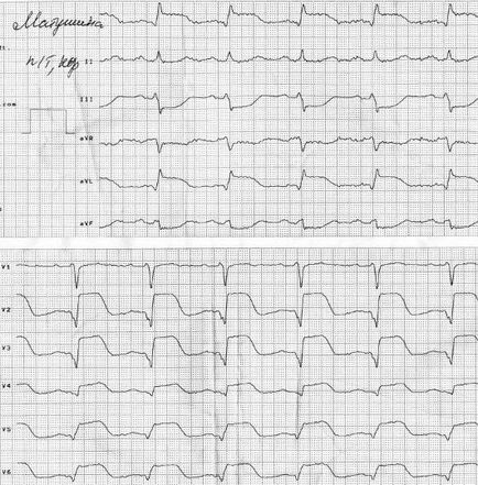 Sindromul coronarian acut