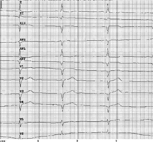 Sindromul coronarian acut