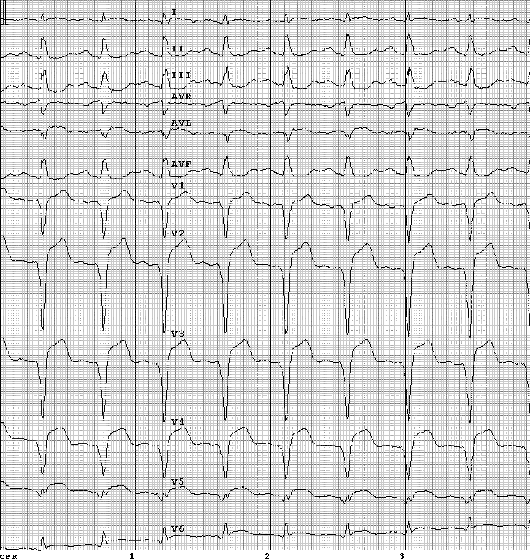 Sindromul coronarian acut