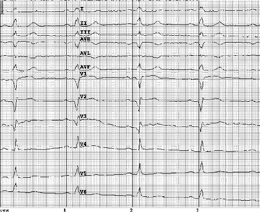 Sindromul coronarian acut