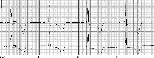 Sindromul coronarian acut