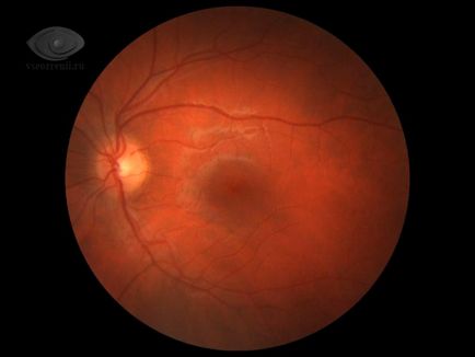 Detașarea retinei, tratamentul cauzelor și simptomelor