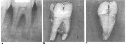 Reacții patologice la medicamente - endodonție, complicații și re-tratament în