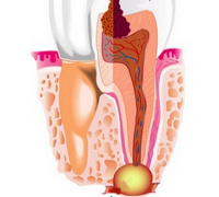 Abces periapical - cauze, simptome, diagnostic și tratament