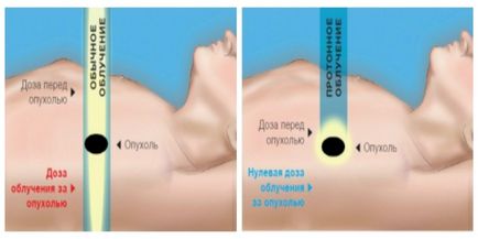 Perspective metode de tratare a bolilor oncologice în captarea neutronului rus și proton