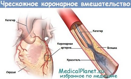 Intervenția percutanată primară (CHK) în infarctul miocardic