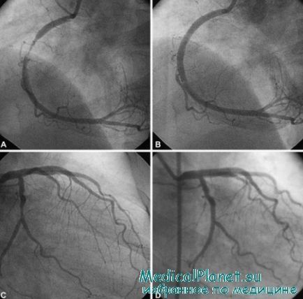 Intervenția percutanată primară (CHK) în infarctul miocardic