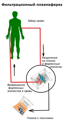 Плазмаферез - чистка крові в москві