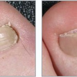 Пліснявий грибок нігтя лікування, симптоми, фото