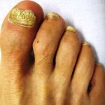 Пліснявий грибок нігтя лікування, симптоми, фото