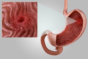 Simptome ulceroase ale stomacului perforate, intervenții chirurgicale, dietă