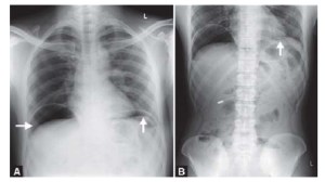 Simptome ulceroase ale stomacului perforate, intervenții chirurgicale, dietă