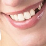 Протезування зубів, віта-дент