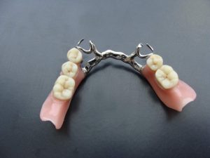 Протезування зубів, віта-дент