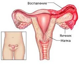 Radio tratamentul valurilor de cancer de col uterin prețurile în Sankt Petersburg, ceea ce este, cauze, simptome,