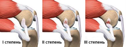 Ruptura ligamentelor din tratamentul articulației genunchiului, simptome și calendarul recuperării la domiciliu