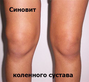 Synovită a tratamentului articulației genunchiului, simptome, fotografii, video ale copilului