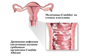 Lumanari depantol descărcare sângeroasă (roz, galben, sânge) - după aplicare