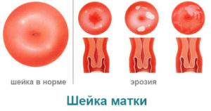 Свічки Депантол кров'янисті виділення (рожеві, жовті, кров'яні) - після застосування