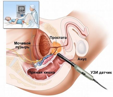 ТРУЗІ передміхурової залози, насінних бульбашок і сечового міхура (трансректально) з КДК в