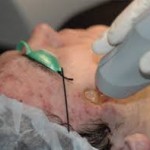 Eliminarea și tratarea petelor negre și a acneei prin laser