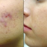 Eliminarea și tratarea petelor negre și a acneei prin laser