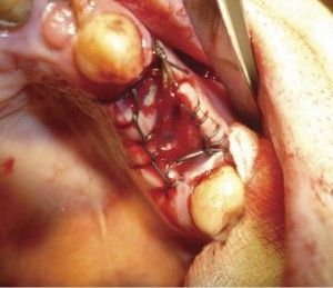 Видалення кореня зуба як видаляють, скільки коштує