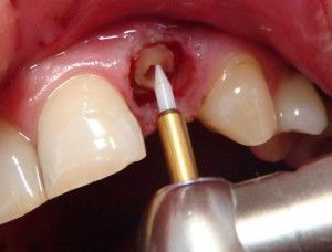 Видалення кореня зуба як видаляють, скільки коштує