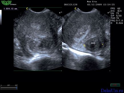 A kismedencei ultrahang nők normális szintre