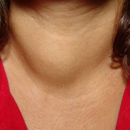Simptomele nodurilor tiroidiene, tratamentul formatiunilor benigne si maligne