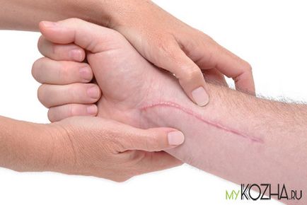 Tipurile de cicatrici (cicatrici) sunt normotrofice, cheloide, hipertrofice, atrofice