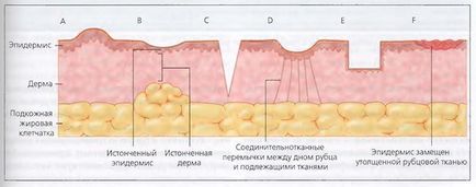 Tratamentul chirurgical al cicatricilor