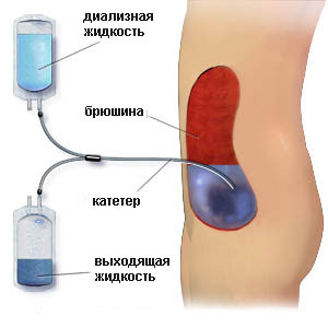 Eșec cronic de rinichi la copii - simptome, tratament, diagnostic,