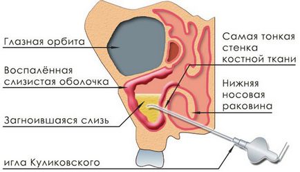 Хронічний гайморит симптоми, лікування, профілактика