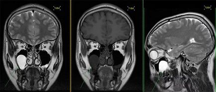 Simptome sinusite cronice, tratament, prevenire