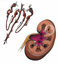 Glomerulonefrita cronică - simptome și tratament