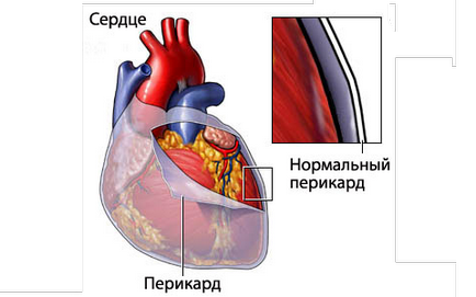 Рідина в серце після операції і інші ускладнення