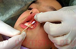 Анестезія в стоматології при личен зубів, види анестезії; лікування зубів під загальною анастезії