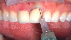 Анестезія в стоматології при личен зубів, види анестезії; лікування зубів під загальною анастезії