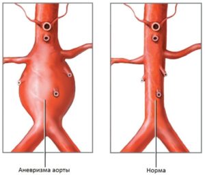 Anevrismul cauzat de aorta, simptomele, diagnosticul și tratamentul