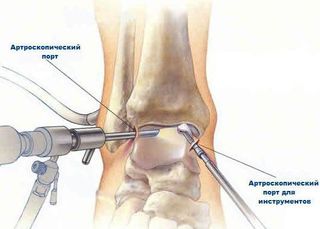 Артроскопія гомілковостопного суглоба і післяопераційне відновлення