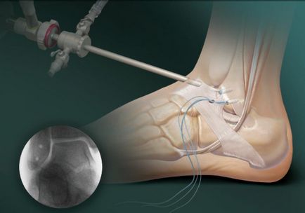Artroszkópiás a bokaízület és a posztoperatív hasznosítás (arthroscopy a boka) Artroszkópiás a bokaízület és a posztoperatív hasznosítás