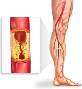 Атеросклероз судин нижніх кінцівок лікування народними засобами